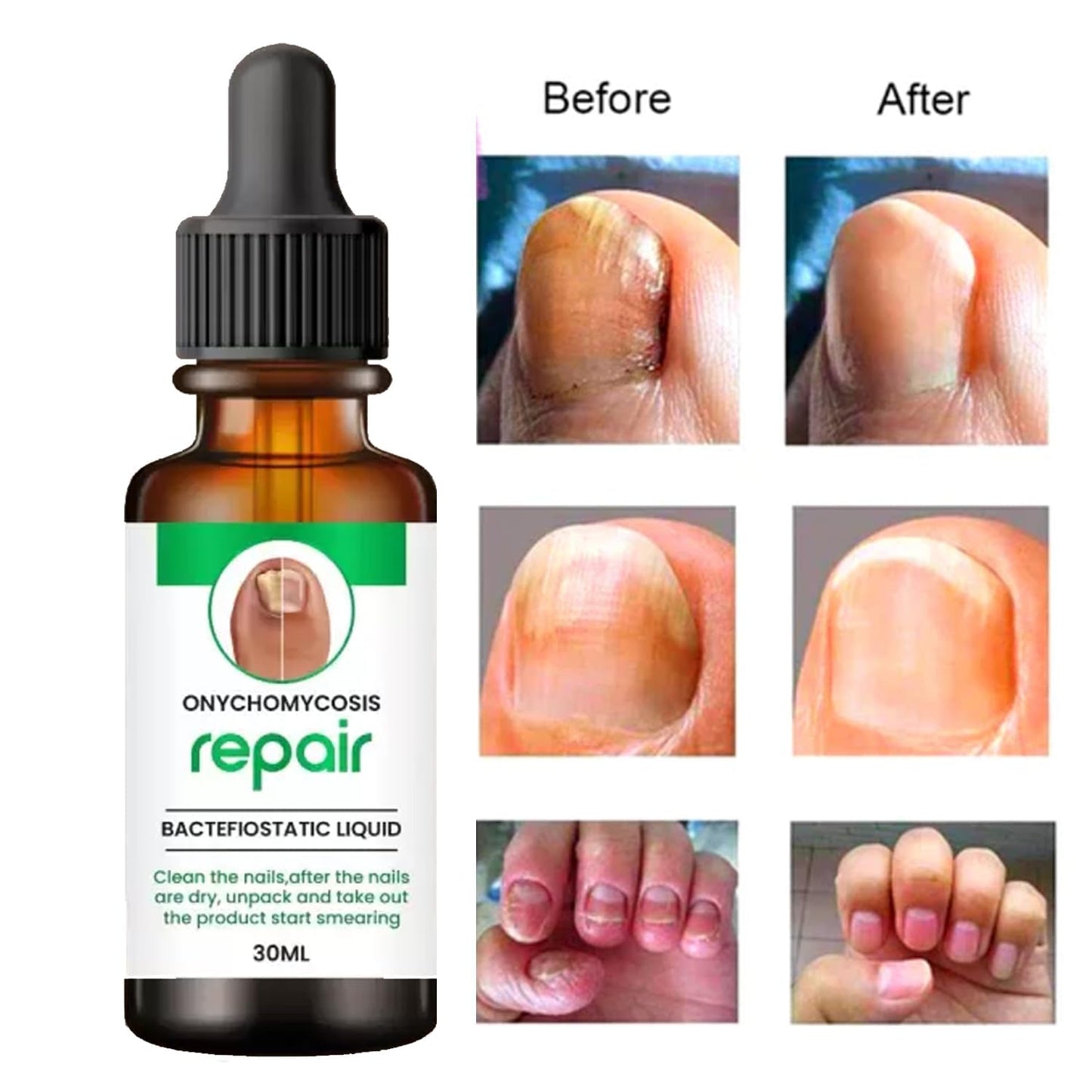 Onychomycosis Repair Bacteriostatic Liquid designed to treat fungal nail infections