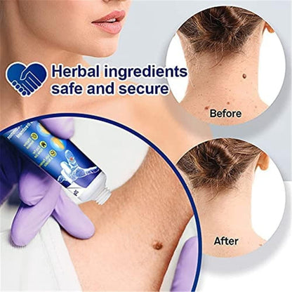 Wart Remover Ointment for All Skin Types 100 gram (Pack of 1)